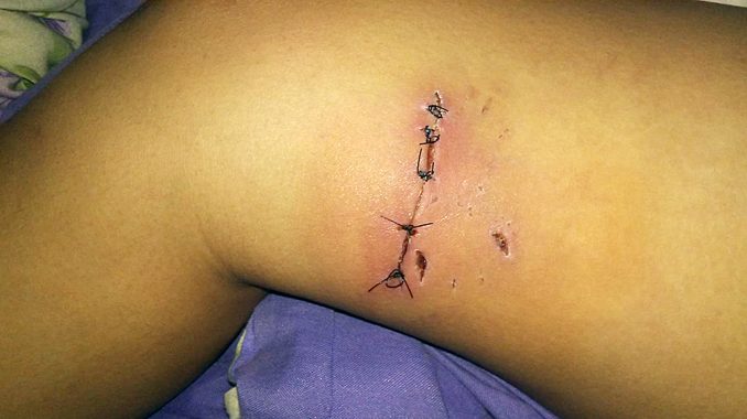 Morteros: Una niña mordida por tres perros Morteros: Una niña mordida por tres perros