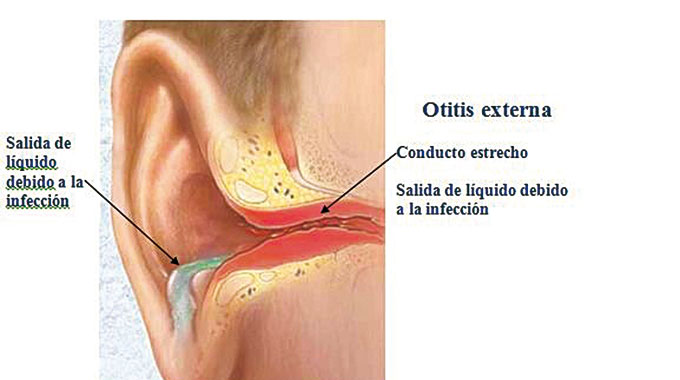 otitis-externa-diario-el-tel-grafo